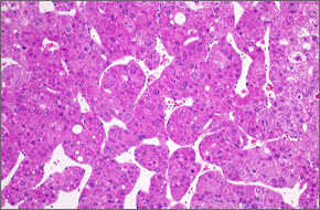 四塩化炭素を2年間吸入したマウスにみられた肝細胞癌（肝臓顕微鏡写真）の写真